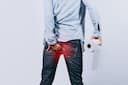 Hemorrhoid Surgery Explained: What to Expect Before, During & After