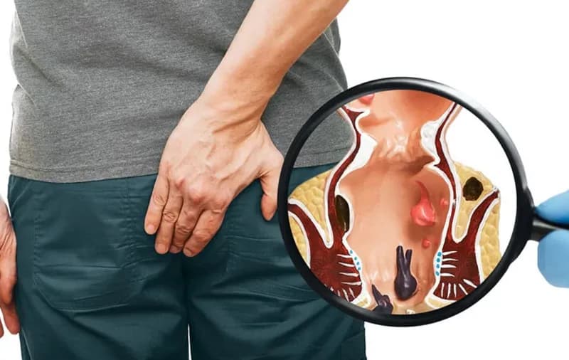 Get Relief from Piles, Fissure & Fistula — Painlessly
